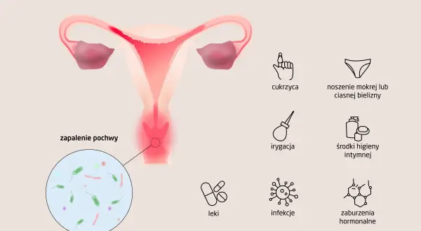 Ilustracja przedstawia przyczyny zapalenia pochwy: cukrzyca, mokra bielizna, irygacja, środki higieny intymnej, leki, infekcje, zaburzenia hormonalne. Widoczne są też bakterie.