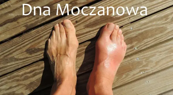 Dwa stopy na drewnianym tarasie. Prawy stopa jest zaczerwieniona i opuchnięta, co sugeruje atak podagry.
