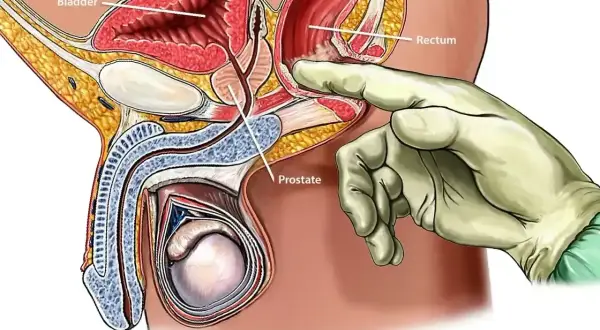 Badanie per rectum: palec w rękawiczce dotyka prostaty, gruczołu znajdującego się poniżej pęcherza moczowego.