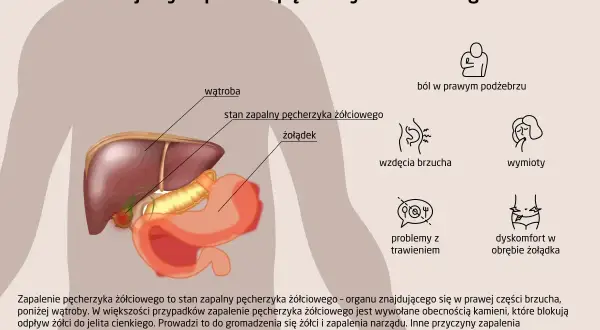 Anatomia człowieka z zaznaczonym pęcherzykiem żółciowym, wątrobą i żołądkiem. Obok objawy zapalenia pęcherzyka żółciowego.