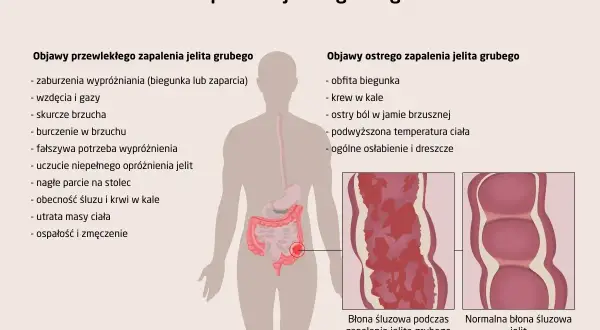 Ilustracja przedstawia objawy zapalenia jelita grubego: przewlekłe (zaburzenia wypróżniania, wzdęcia, skurcze) i ostre (biegunka, krew w kale, ból brzucha). Pokazuje też wygląd błony śluzowej jelita.