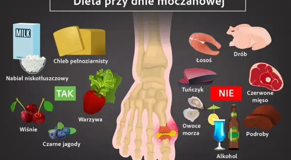 Dieta przy dnie moczanowej: TAK - nabiał niskotłuszczowy, chleb pełnoziarnisty, warzywa, wiśnie, czarne jagody. NIE - drób, łosoś, tuńczyk, czerwone mięso, owoce morza, alkohol, podroby. Jak obniżyć kwas moczowy?