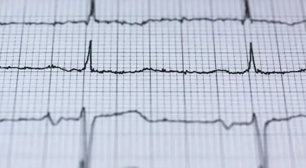 Nieregularne linie EKG na papierze milimetrowym, wskazujące na migotanie przedsionków.