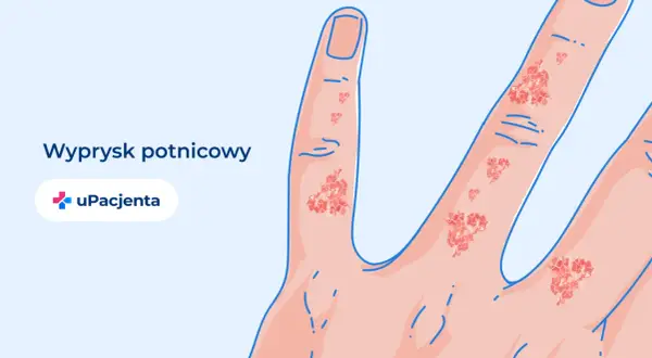 Ilustracja przedstawia dłoń z widocznym wypryskiem potnicowym na palcach.
