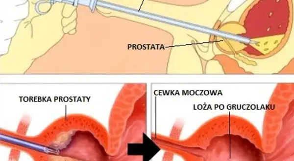 Czy pacjent ma prawo do sanatorium po operacji prostaty? Sprawdź warunki