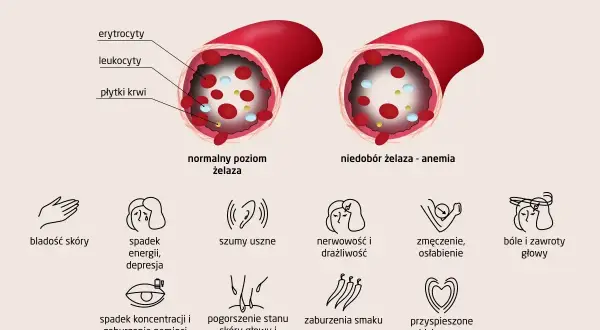 Niedobór żelaza - anemia objawia się bladością skóry, spadkiem energii, szumami usznymi, zmęczeniem, bólami głowy i innymi symptomami.