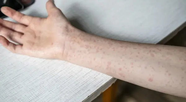 Ręka pokryta drobnymi, czerwonymi plamkami, które mogą być objawem odry.