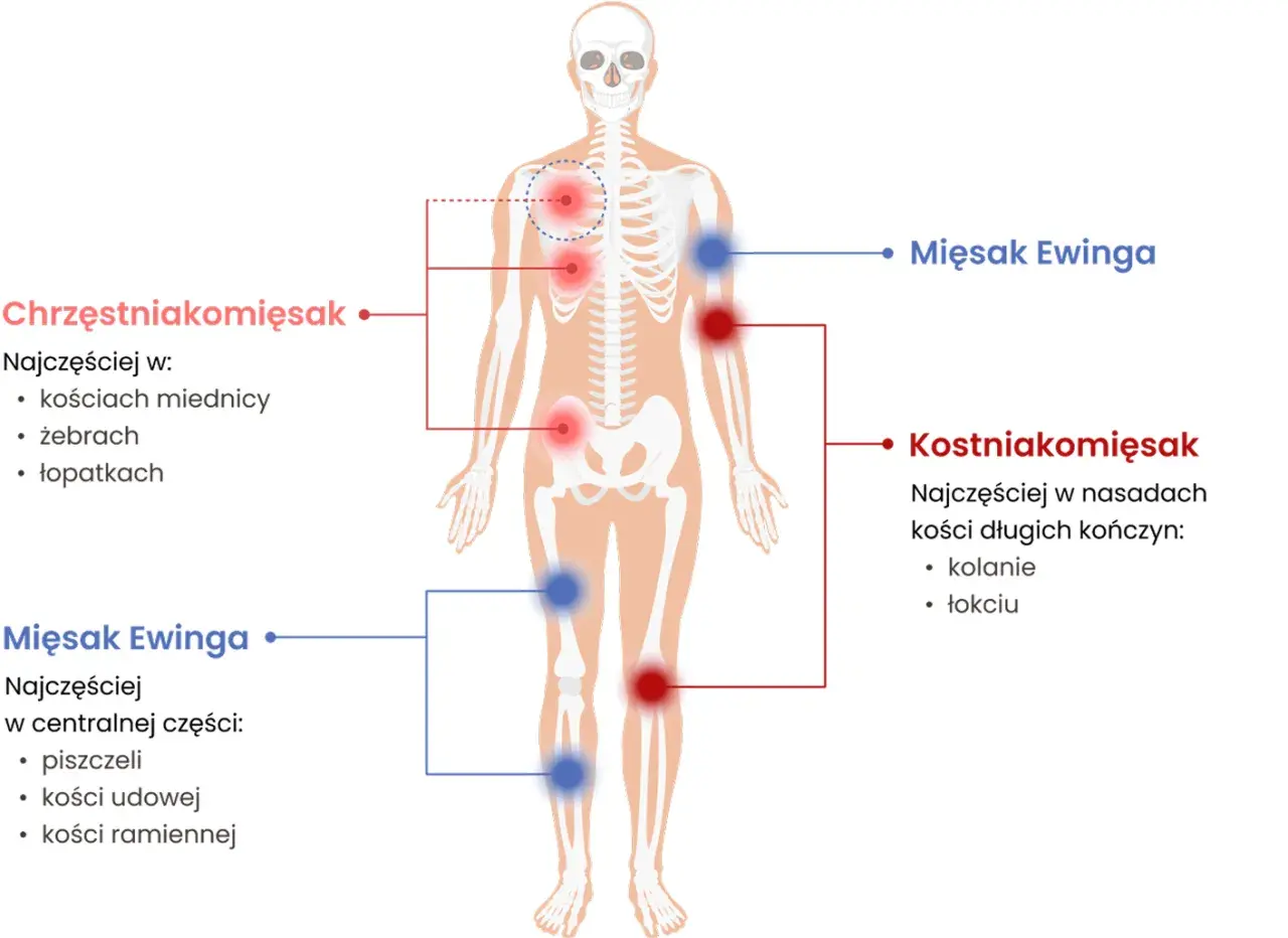 Schemat pokazuje lokalizację mięsaków: mięsak Ewinga w centralnej części ciała (piszczel, kość udowa, ramienna), a kostniakomięsak w nasadach kości długich.