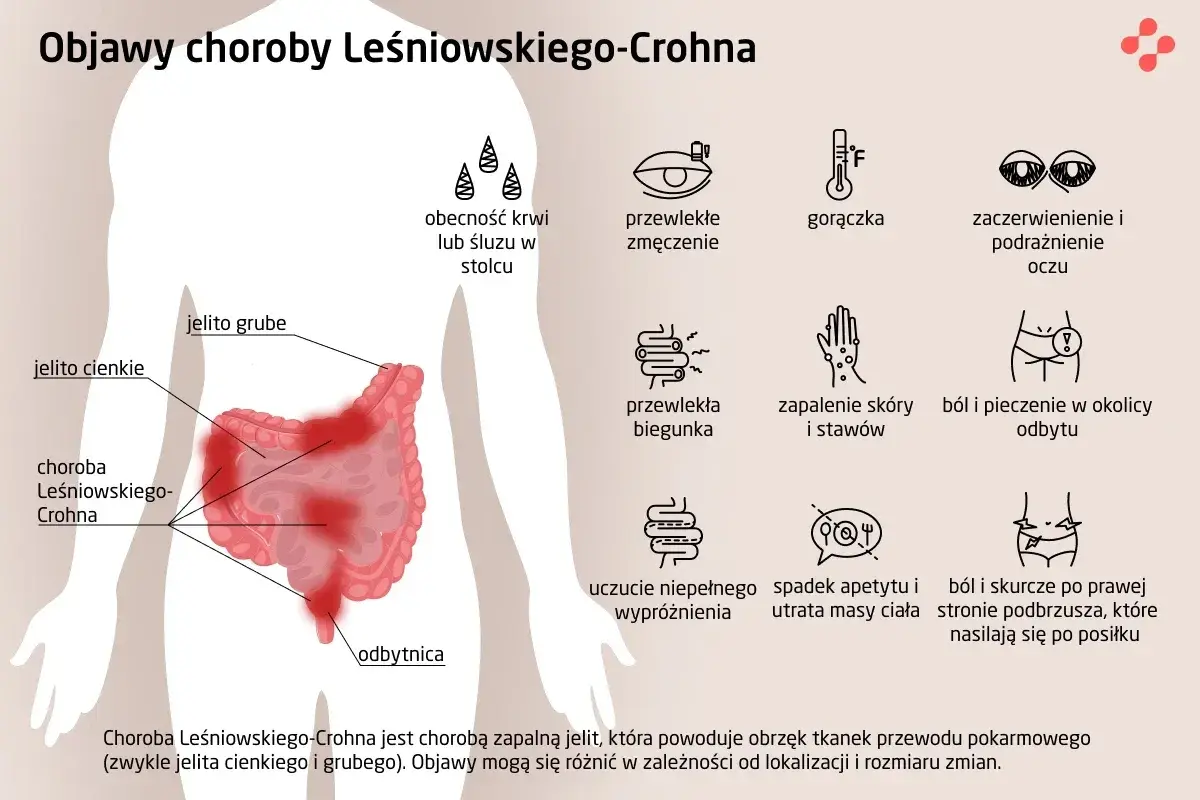 Objawy choroby Leśniowskiego-Crohna: ból brzucha, biegunka, zmęczenie, gorączka, problemy ze skórą i oczami.