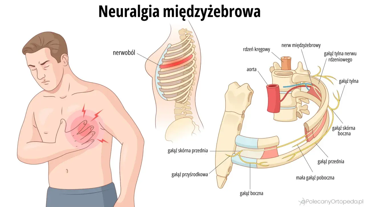 Ilustracja pokazuje mężczyznę z bólem w klatce piersiowej, symbolizującym **neuralgię międzyżebrową**. Widoczne są żebra, kręgosłup i nerwy.