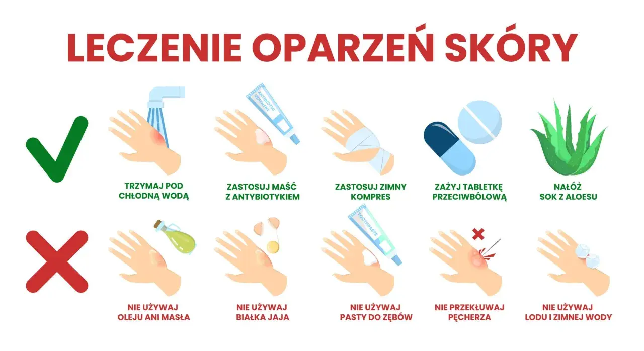 Ilustracja pokazuje, jak leczyć oparzenia 2 stopnia: chłodna woda, maść z antybiotykiem, zimny kompres, tabletki przeciwbólowe, aloes. Nie używaj masła, jajka, pasty do zębów, lodu.