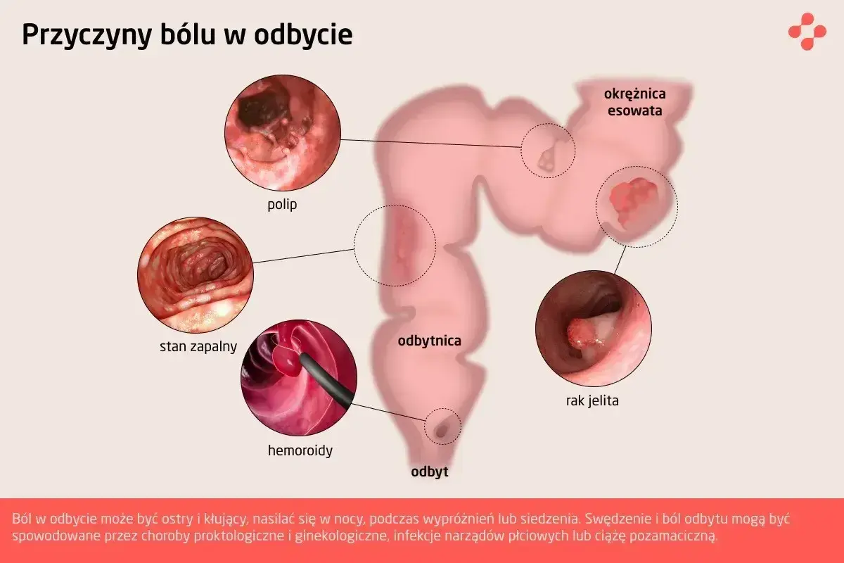 Ilustracja przedstawia przyczyny bólu w odbycie: polip, stan zapalny, hemoroidy, okrężnicę esowatą i raka jelita. Objaw Blumberga może towarzyszyć tym schorzeniom.