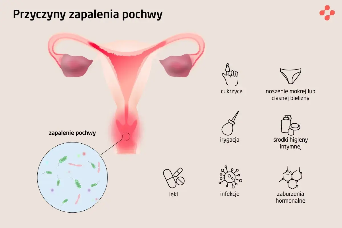 Ilustracja przedstawia przyczyny zapalenia pochwy: cukrzyca, mokra bielizna, irygacja, środki higieny intymnej, leki, infekcje, zaburzenia hormonalne. Widoczne są też bakterie.