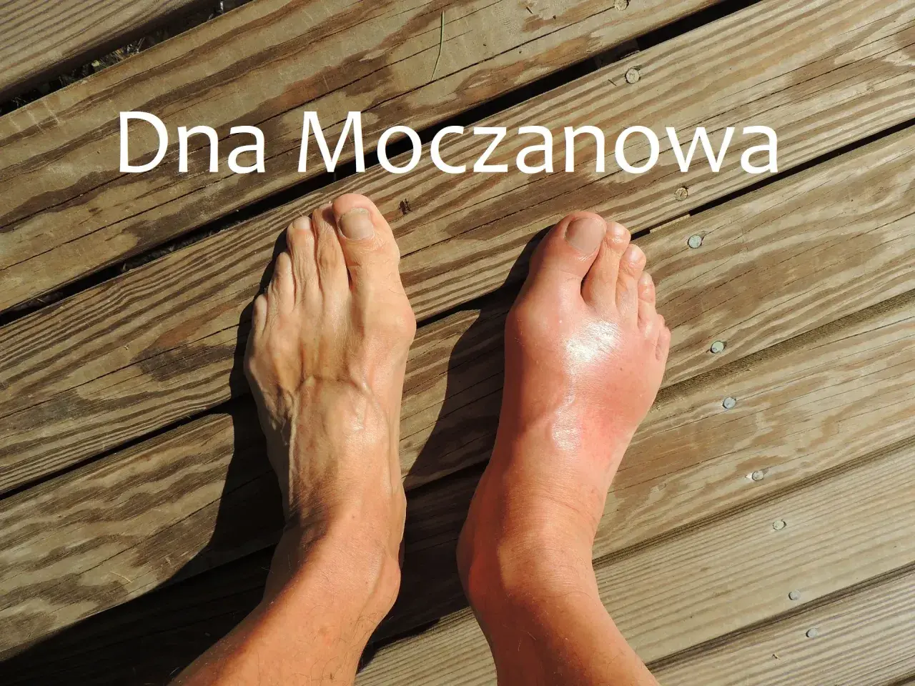 Dwa stopy na drewnianym tarasie. Prawy stopa jest zaczerwieniona i opuchnięta, co sugeruje atak podagry.