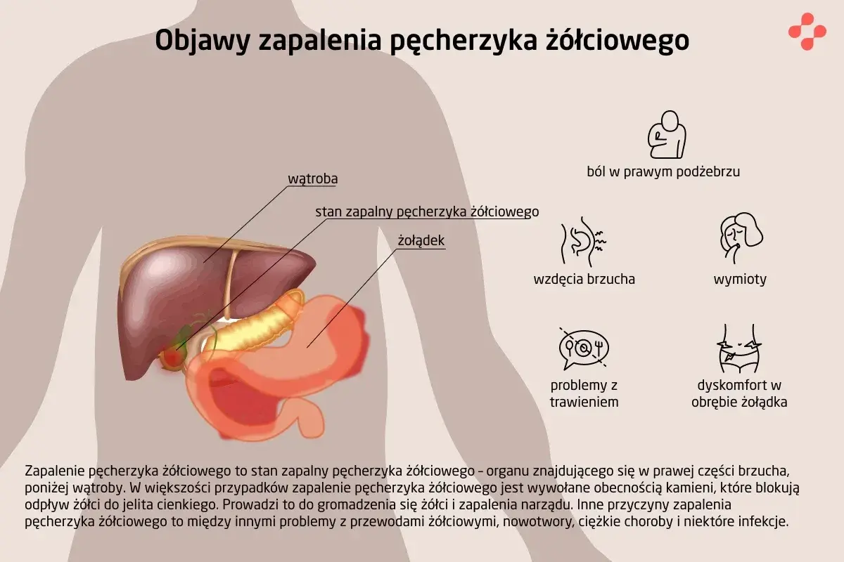 Anatomia człowieka z zaznaczonym pęcherzykiem żółciowym, wątrobą i żołądkiem. Obok objawy zapalenia pęcherzyka żółciowego.
