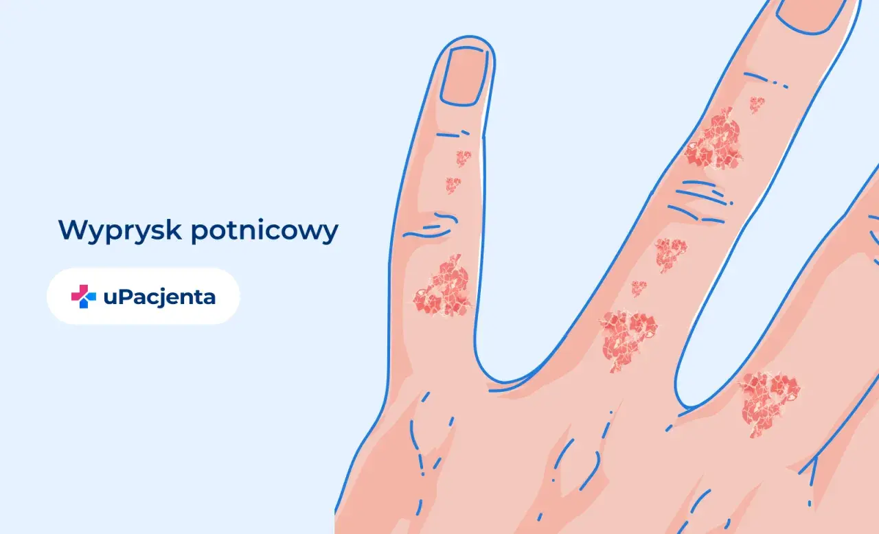 Ilustracja przedstawia dłoń z widocznym wypryskiem potnicowym na palcach.