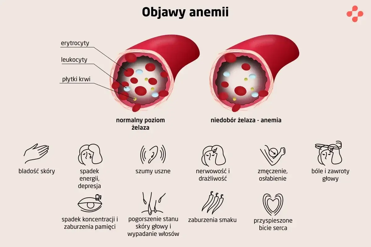 Niedobór żelaza - anemia objawia się bladością skóry, spadkiem energii, szumami usznymi, zmęczeniem, bólami głowy i innymi symptomami.
