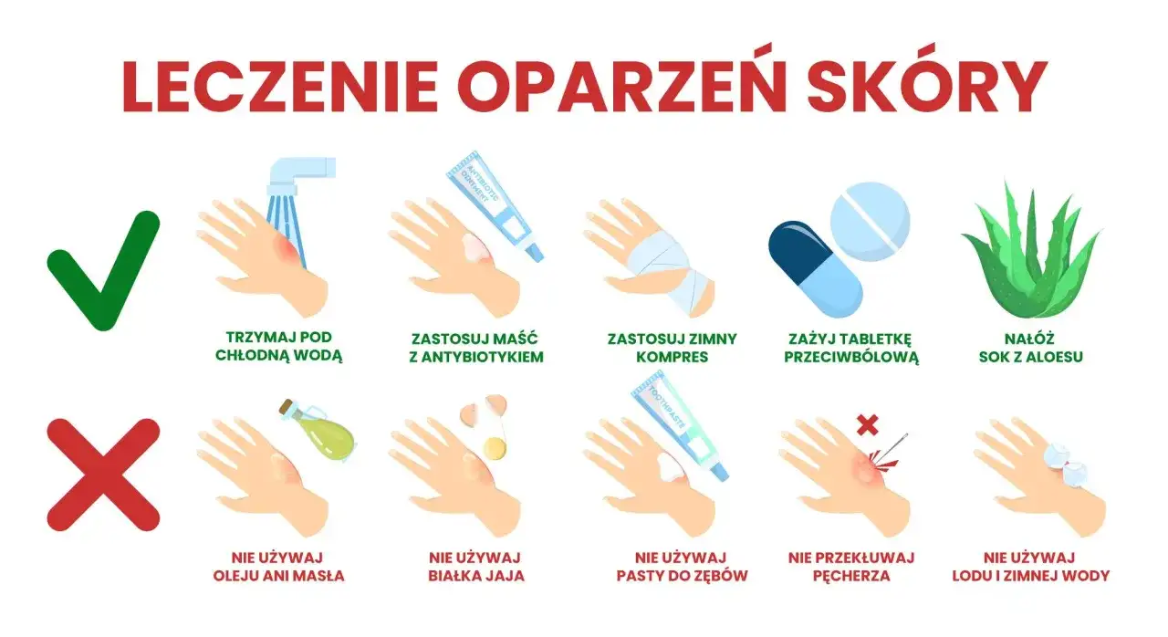 Ilustracja pokazuje, jak leczyć oparzenia 2 stopnia: chłodna woda, maść z antybiotykiem, zimny kompres, tabletki przeciwbólowe, aloes. Nie używaj masła, jajka, pasty do zębów, lodu.