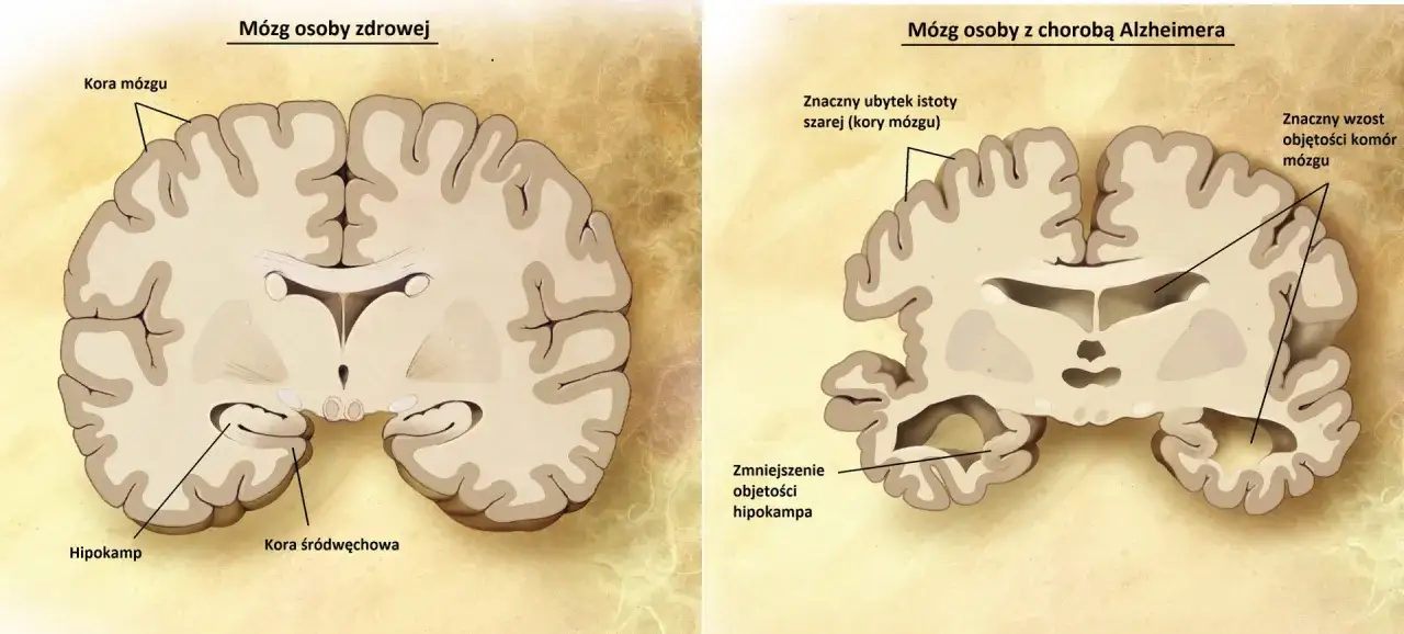 Porównanie mózgu zdrowego i z chorobą Alzheimera. Widoczne zmniejszenie hipokampa i kory mózgowej, co jest jednym z objawów alzheimera.