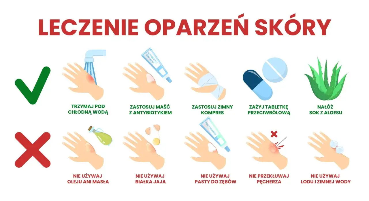 Ilustracja pokazuje, jak leczyć oparzenia 2 stopnia: chłodna woda, maść z antybiotykiem, zimny kompres, tabletki przeciwbólowe, aloes. Nie stosuj masła, jajka, pasty do zębów, lodu.