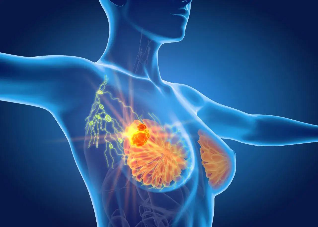 Anatomical illustration showing a tumor in the breast and enlarged lymph nodes in the armpit, indicating potential spread and causing ból pod pachą.