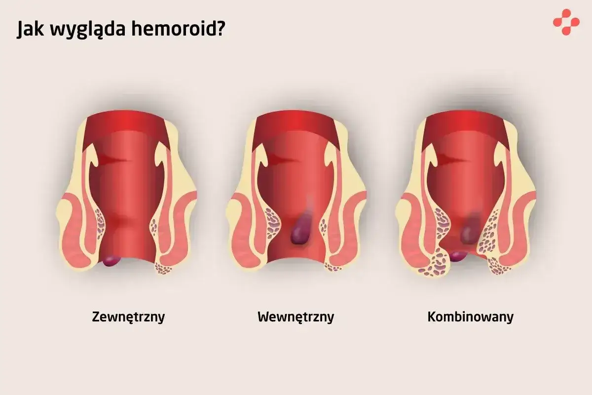 Ilustracja pokazuje trzy rodzaje hemoroidów: zewnętrzne, wewnętrzne i kombinowane. Nie są to zdjęcia raka odbytu.