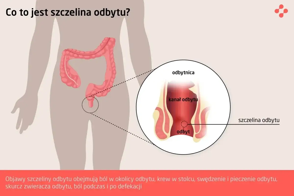 Ilustracja przedstawia anatomię odbytu z zaznaczoną szczeliną. Objawy szczeliny odbytu to ból, krwawienie i pieczenie.