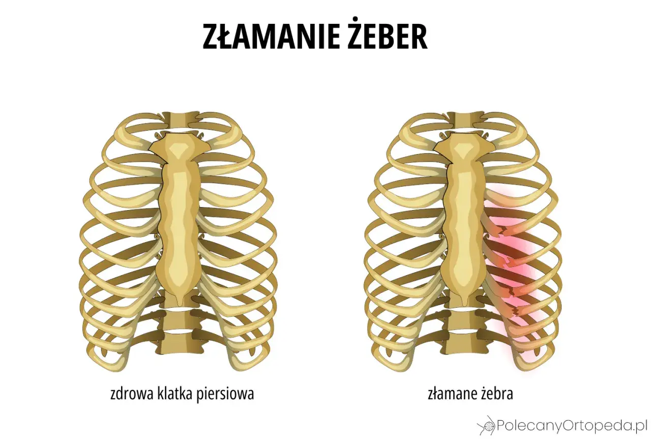 Porównanie zdrowej klatki piersiowej z klatką ze złamanymi żebrami, gdzie uszkodzone żebra są zaznaczone na czerwono.