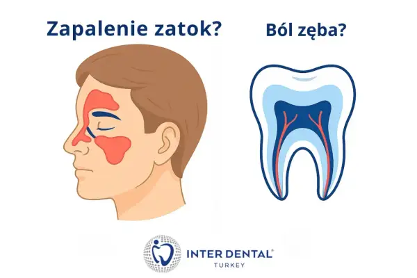 Zapalenie zatok czy ból zęba? Ilustracja pokazuje obszary zatok na twarzy i przekrój zęba.