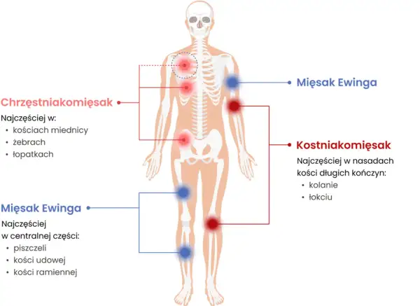 Schemat pokazuje lokalizację mięsaków: mięsak Ewinga w centralnej części ciała (piszczel, kość udowa, ramienna), a kostniakomięsak w nasadach kości długich.