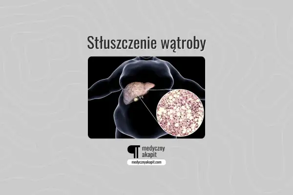 Stłuszczenie wątroby: obraz przedstawia sylwetkę osoby z widoczną wątrobą i powiększony fragment tkanki wątrobowej z komórkami tłuszczowymi.