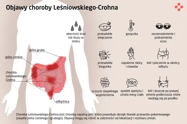 Objawy choroby Leśniowskiego-Crohna: ból brzucha, biegunka, zmęczenie, gorączka, problemy ze skórą i oczami.