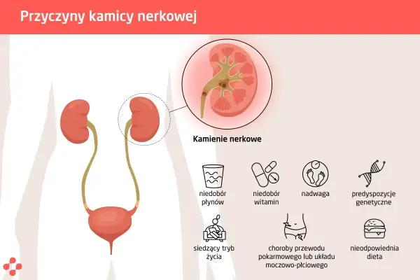 Ilustracja przedstawia przyczyny kamicy nerkowej: niedobór płynów, witamin, siedzący tryb życia, nadwagę, choroby układu pokarmowego i moczowo-płciowego, nieodpowiednią dietę oraz predyspozycje genetyczne.
