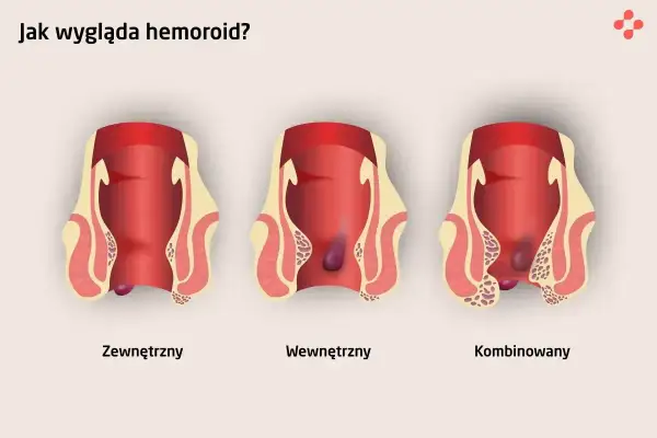 Ilustracja pokazuje trzy rodzaje hemoroidów: zewnętrzne, wewnętrzne i kombinowane. Nie są to zdjęcia raka odbytu.