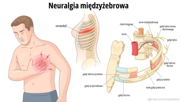 Ilustracja pokazuje mężczyznę z bólem w klatce piersiowej, symbolizującym **neuralgię międzyżebrową**. Widoczne są żebra, kręgosłup i nerwy.