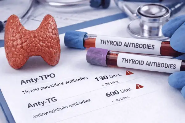 Model tarczycy, probówki z napisem "THYROID ANTIBODIES" i wyniki badań, wskazujące na podwyższone atg.