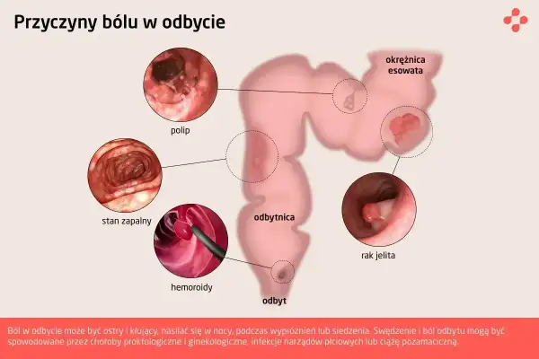 Ilustracja przedstawia przyczyny bólu w odbycie: polip, stan zapalny, hemoroidy, okrężnicę esowatą i raka jelita. Objaw Blumberga może towarzyszyć tym schorzeniom.