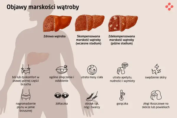 Objawy marskości wątroby: ból brzucha, zmęczenie, utrata masy ciała, żółtaczka, obrzęki, gorączka, swędzenie skóry.