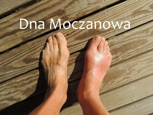 Dwa stopy na drewnianym tarasie. Prawy stopa jest zaczerwieniona i opuchnięta, co sugeruje atak podagry.