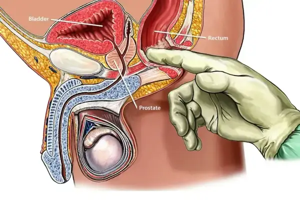 Badanie per rectum: palec w rękawiczce dotyka prostaty, gruczołu znajdującego się poniżej pęcherza moczowego.