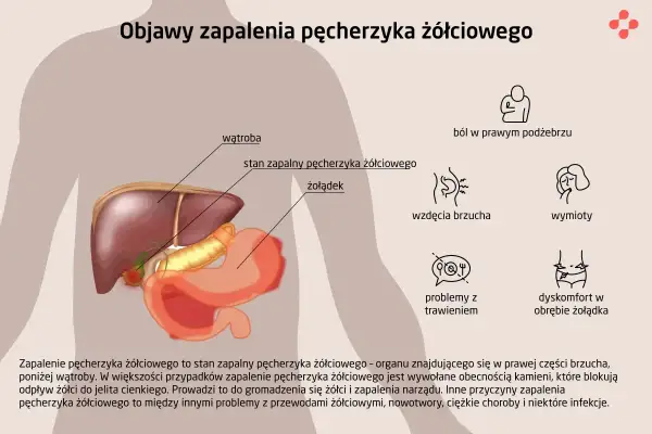 Anatomia człowieka z zaznaczonym pęcherzykiem żółciowym, wątrobą i żołądkiem. Obok objawy zapalenia pęcherzyka żółciowego.