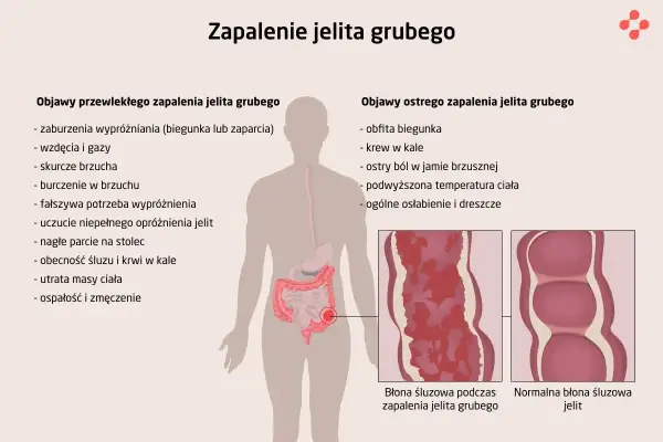Ilustracja przedstawia objawy zapalenia jelita grubego: przewlekłe (zaburzenia wypróżniania, wzdęcia, skurcze) i ostre (biegunka, krew w kale, ból brzucha). Pokazuje też wygląd błony śluzowej jelita.