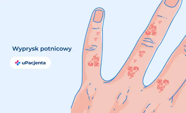 Ilustracja przedstawia dłoń z widocznym wypryskiem potnicowym na palcach.