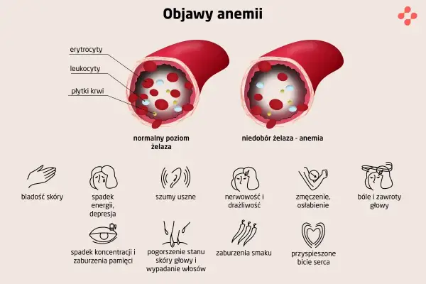 Niedobór żelaza - anemia objawia się bladością skóry, spadkiem energii, szumami usznymi, zmęczeniem, bólami głowy i innymi symptomami.