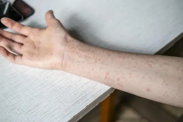 Ręka pokryta drobnymi, czerwonymi plamkami, które mogą być objawem odry.